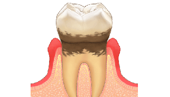 「歯周炎」中期