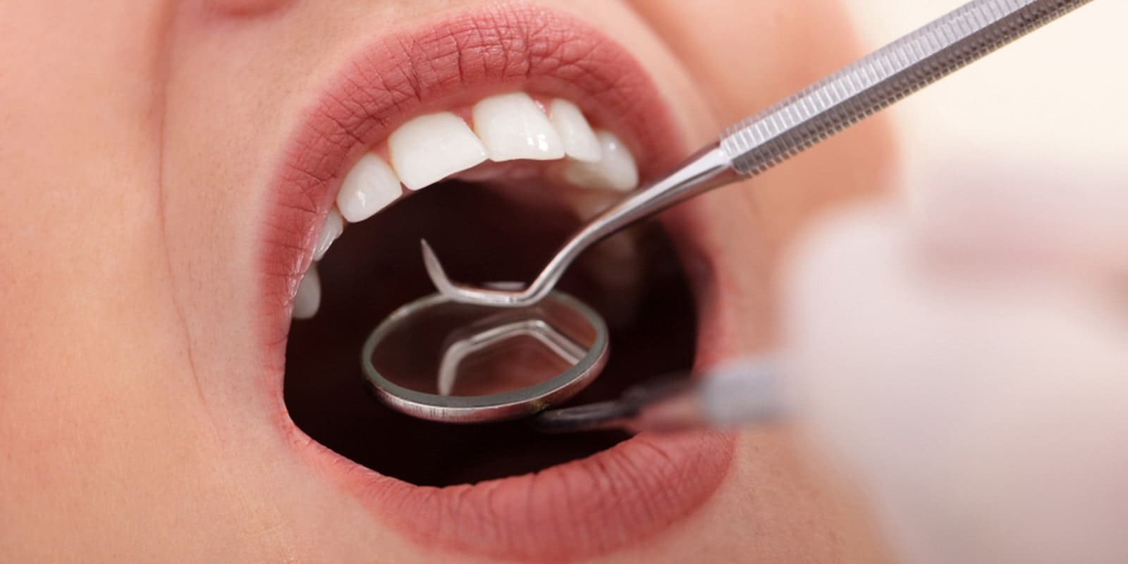 日本と欧米の予防歯科に対する根本的な違いについて